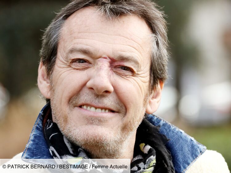 Jean Luc Reichmann Pourquoi A T Il Une Tache Sur Le Nez Femme