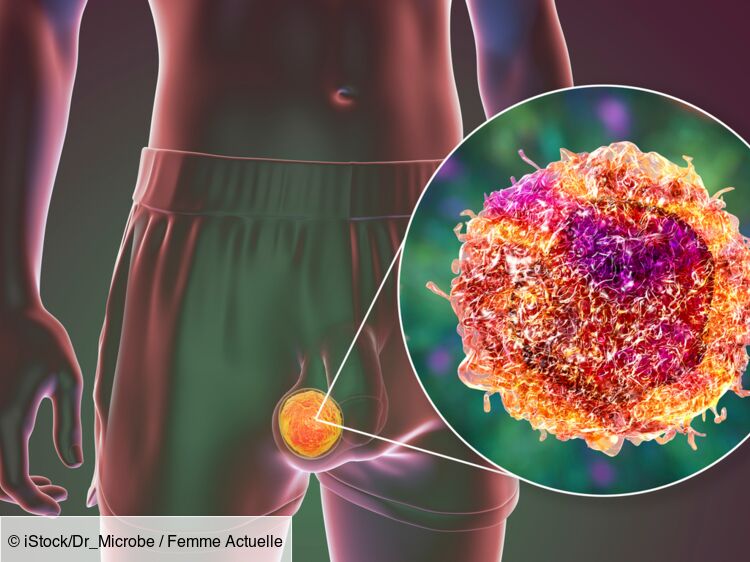 Cancer Des Testicules Causes Sympt Mes Impact Sur La Fertilit