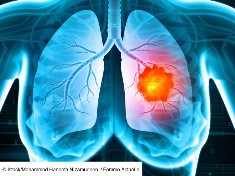 Traitements Du Cancer Du Poumon Comment Se Soigne T Il Selon Le Stade