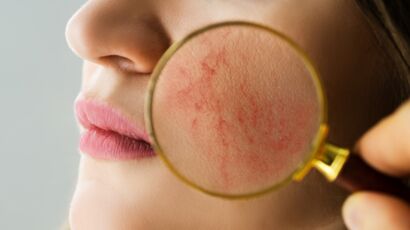 Dermatophytoses Teigne Causes Sympt Mes Transmission Traitement