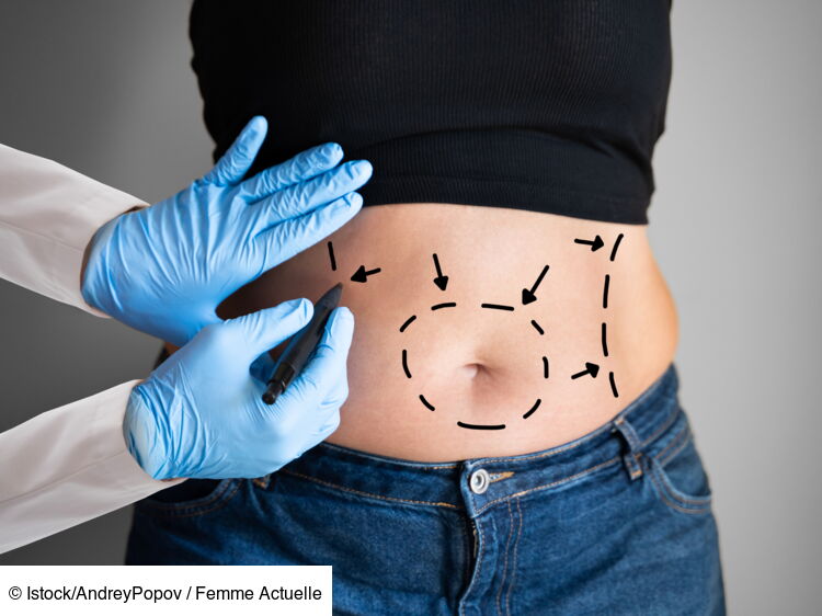 Abdominoplastie définition déroulement et convalescence Femme