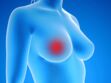 Cancer du sein : la radiothérapie sur mesure