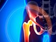 Arthrose : une nouvelle prothèse de hanche révolutionnaire ?