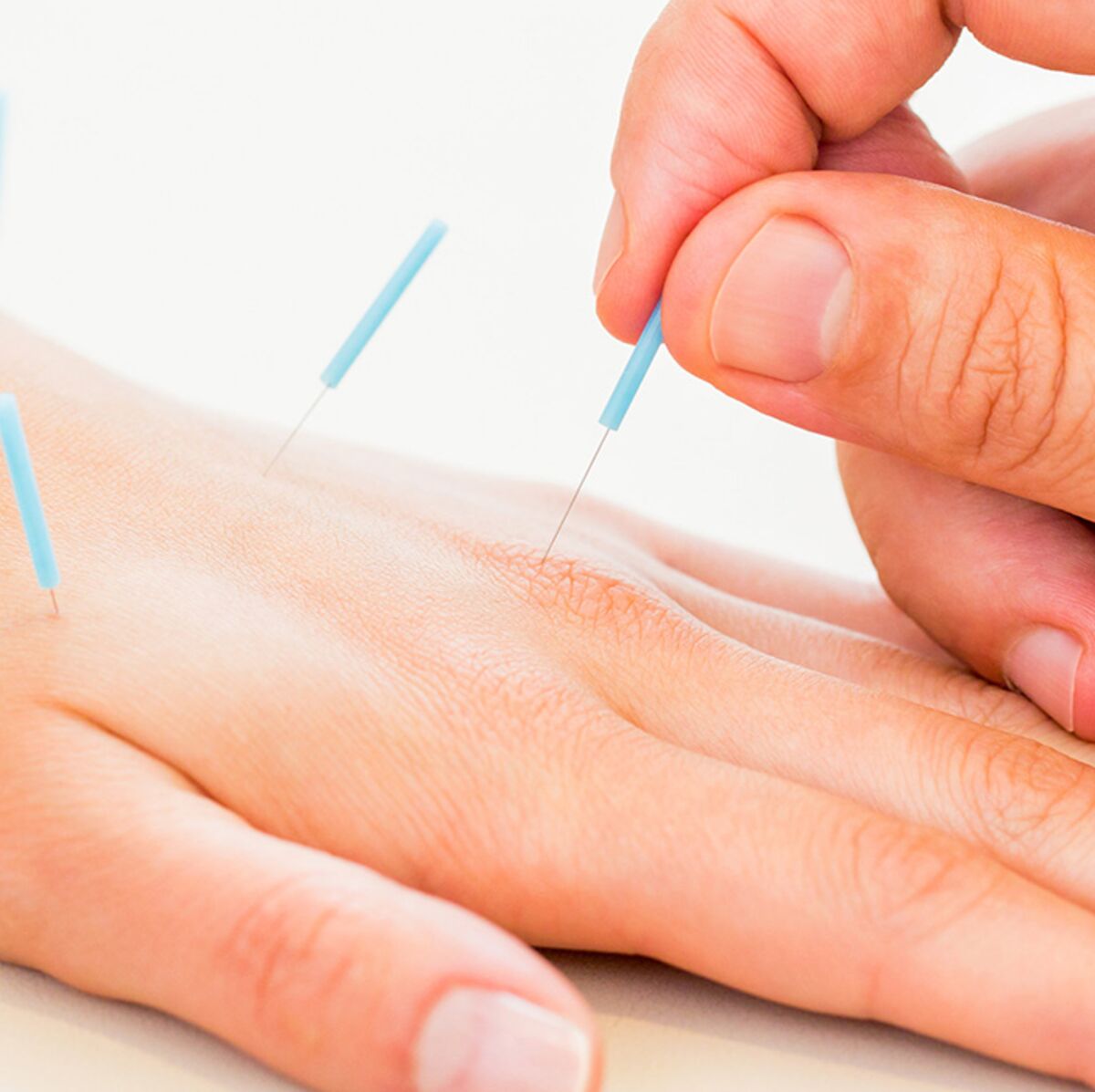 Canal carpien : de l'acupuncture pour soulager les douleurs ...