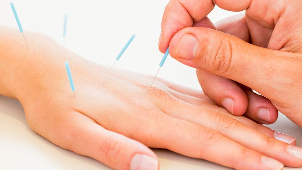 Canal carpien : de l’acupuncture pour soulager les douleurs