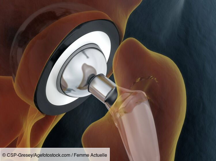 metode de tratament chirurgical al artrozei artroza și artrita articulației cotului