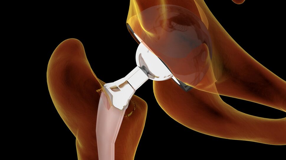Une nouvelle prothèse de hanche révolutionnaire ?