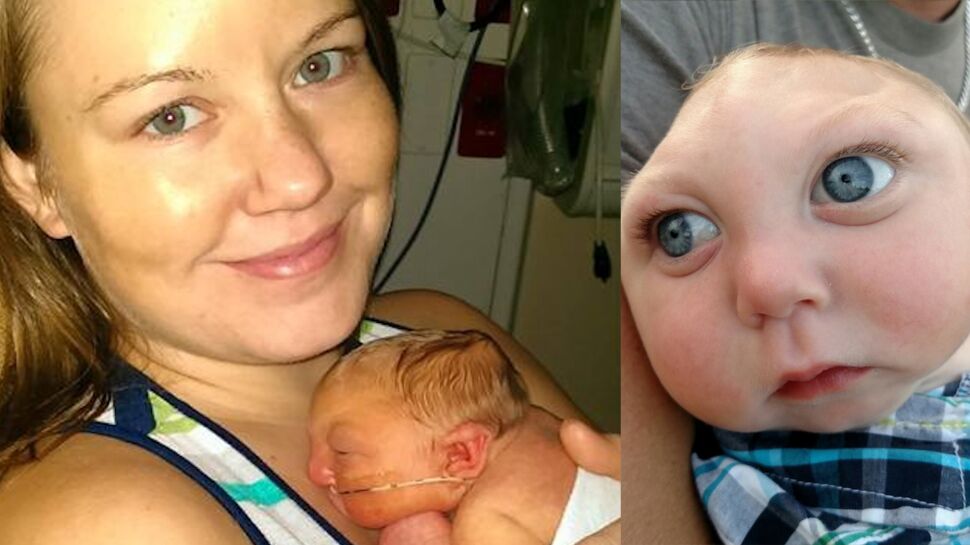 Ce bébé atteint d’une malformation crânienne défie les pronostics et fête son 1er anniversaire