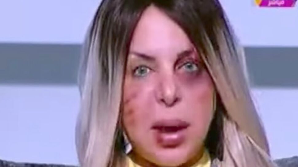 Une journaliste présente son émission le visage tuméfié pour dénoncer les violences faites aux femmes