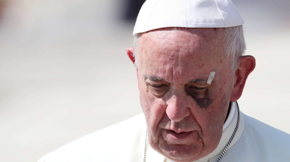 Pourquoi le pape a-t-il un œil au beurre noir ?