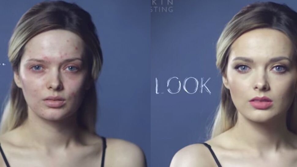 Vidéo : Une youtubeuse beauté souffrant d’acné dénonce le harcèlement des internautes