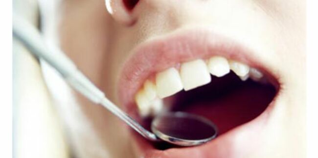 Blanchiment des dents : quelle méthode choisir ?