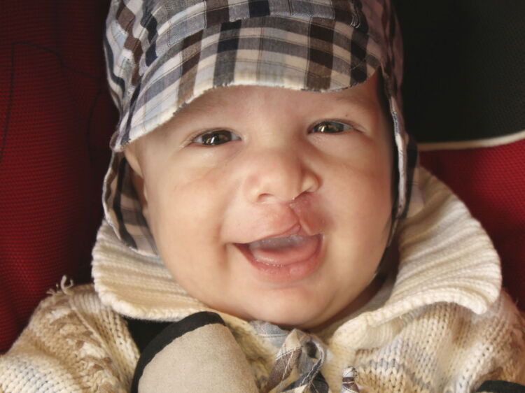 Fente labiopalatine tout savoir sur le becdelièvre Femme Actuelle Le MAG