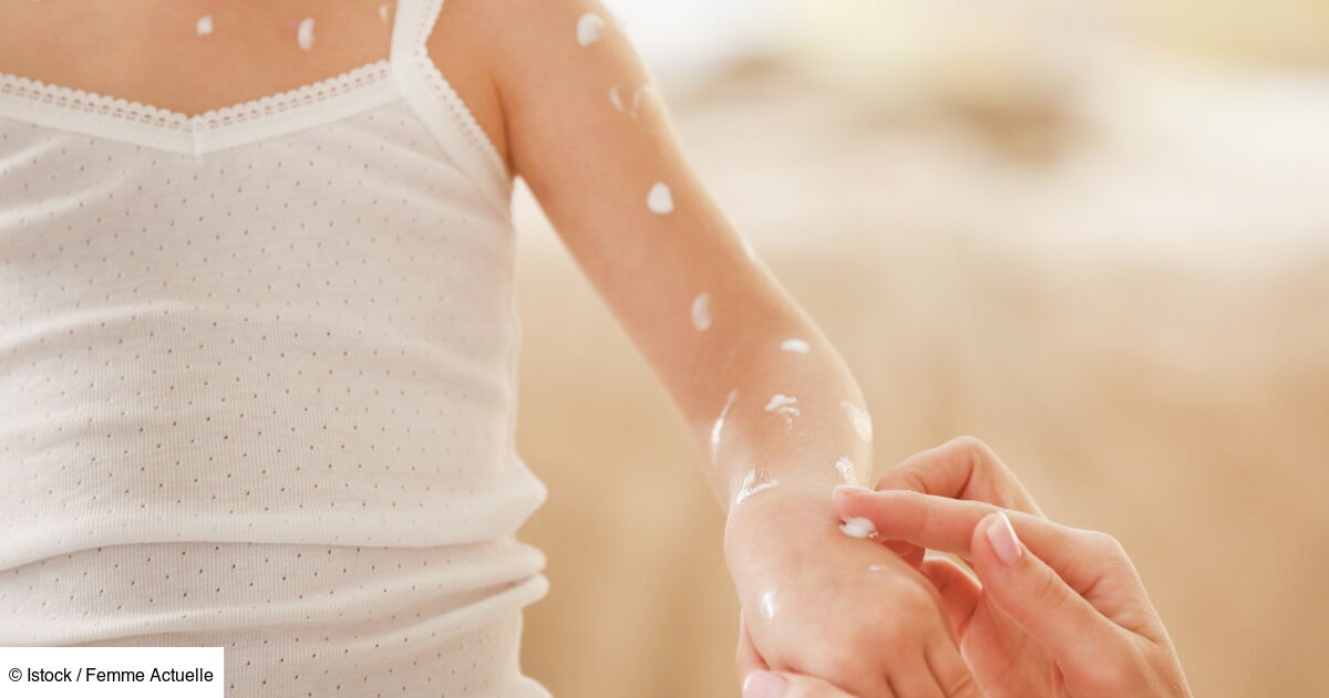 Boutons de varicelle : 10 astuces naturelles pour éviter les cicatrices