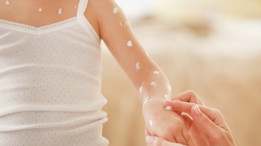 Boutons de varicelle : 10 astuces naturelles pour éviter les cicatrices