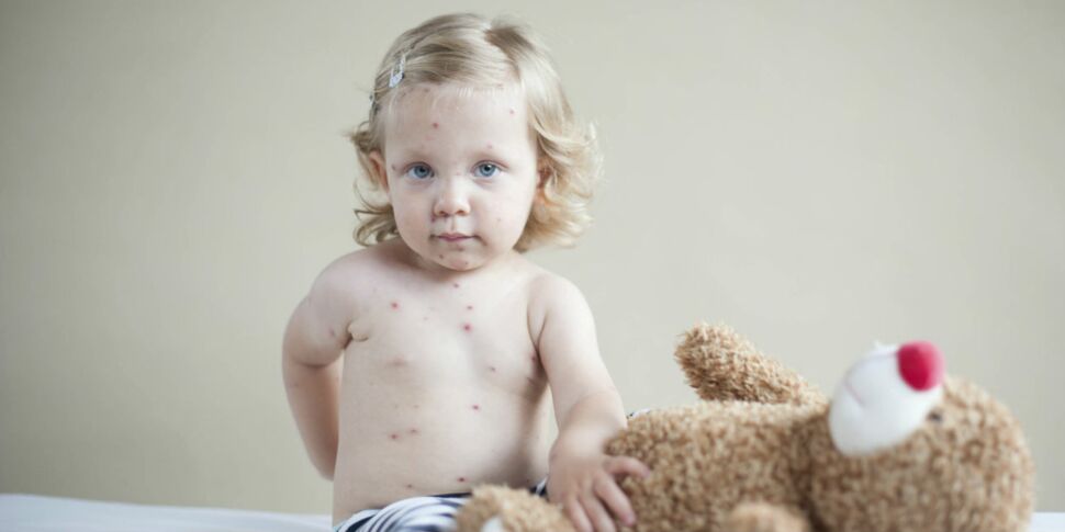 Boutons chez l’enfant : reconnaître la varicelle et la rubéole