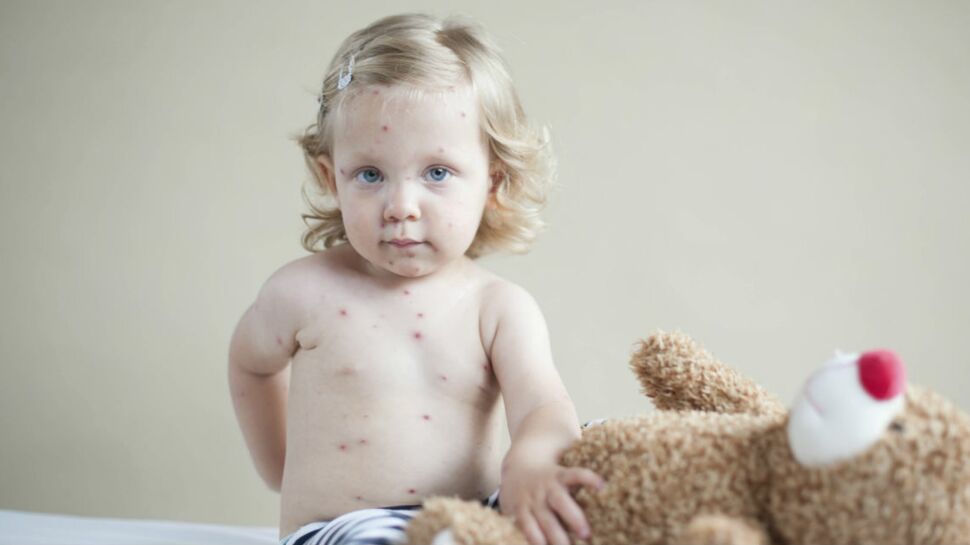 Boutons chez l'enfant : reconnaître la varicelle et la rubéole ...