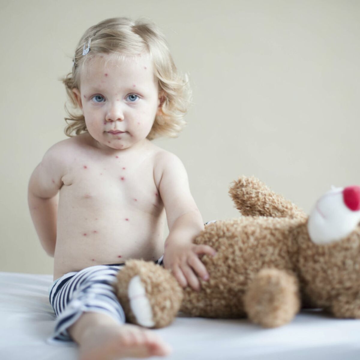 Boutons chez l'enfant : reconnaître la varicelle et la rubéole ...