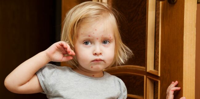 Les complications de la varicelle chez l'enfant