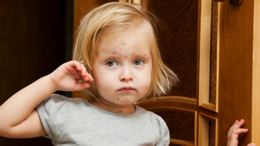 Les complications de la varicelle chez l'enfant