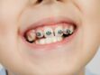 Quand emmener son enfant chez l'orthodontiste ? Les signes qui ne trompent pas