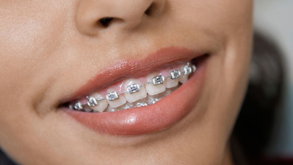 Adolescents : gare aux appareils dentaires faits-maison !