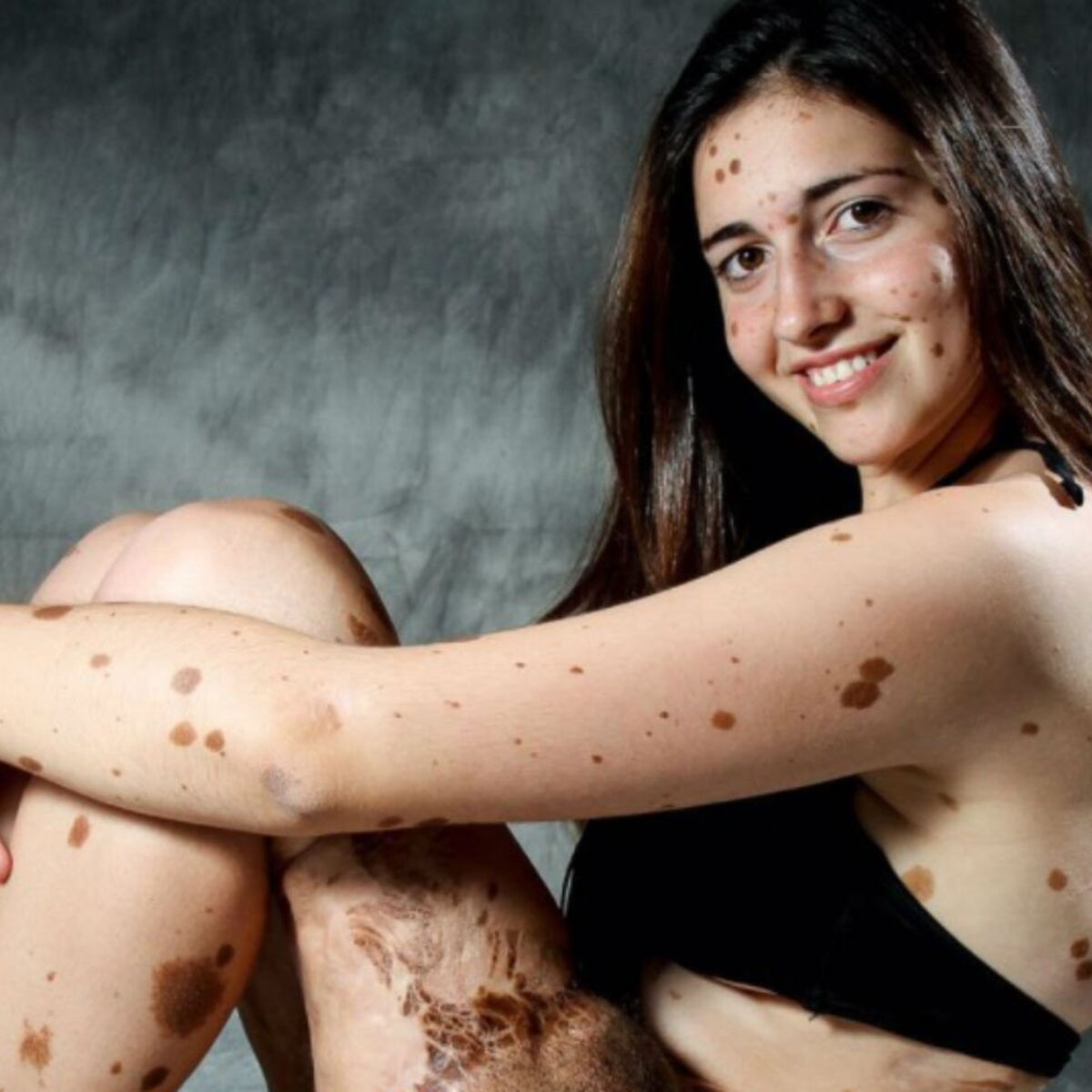 Moquee Pour Avoir Le Corps Couvert De Grains De Beaute Cette Ado Se Lance Dans Le Mannequinat Femme Actuelle Le Mag