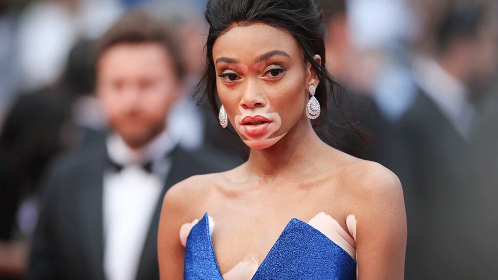 Un mannequin atteint de vitiligo sur tout le visage, Winnie Harlow, a fait sensation à Cannes