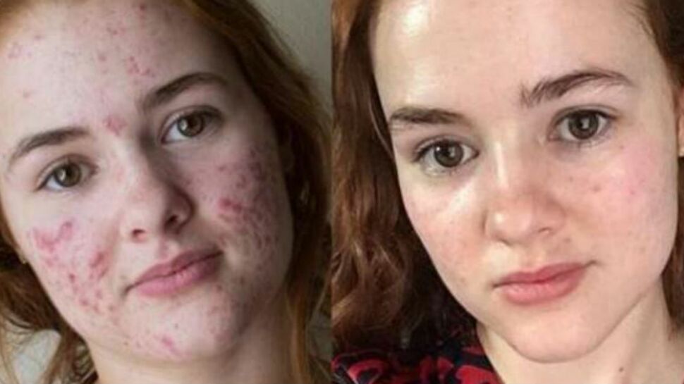 Acné sévère : une jeune femme partage un avant/après de sa peau sur Instagram