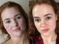 Acné sévère : une jeune femme partage un avant/après de sa peau sur Instagram
