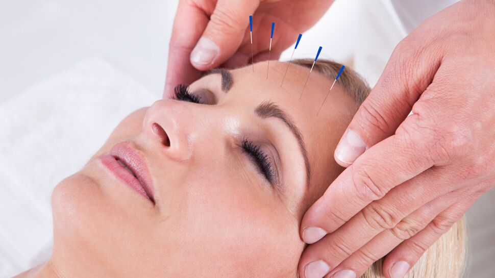 L’acupuncture réduirait la fréquence des migraines