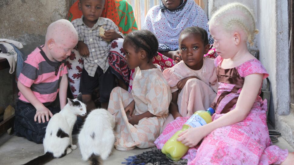Un adolescent albinos mutilé, son cerveau disparu