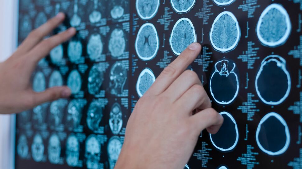 Alzheimer : des chercheurs pensent avoir trouvé un signe précoce de la maladie
