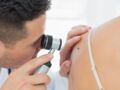 Cancer de la peau : des chercheurs ont mis au point un test sanguin capable de détecter le mélanome