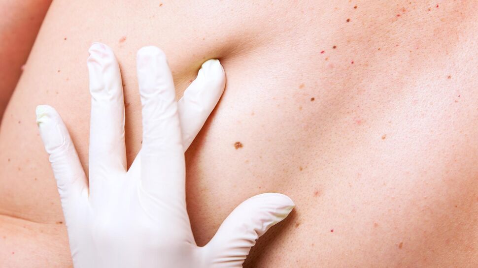 Cancer de la peau : une molécule tueuse de mélanomes