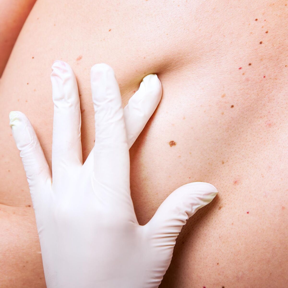 Cancer de la peau : une molécule tueuse de mélanomes : Femme ...