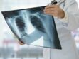 Cancer du poumon : une cagnotte en ligne pour financer la recherche