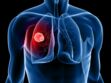 Cancer du poumon : une nouvelle thérapie a permis de bloquer la progression de la maladie