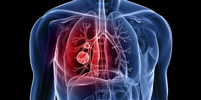 Cancer du poumon : un diagnostic simplifié