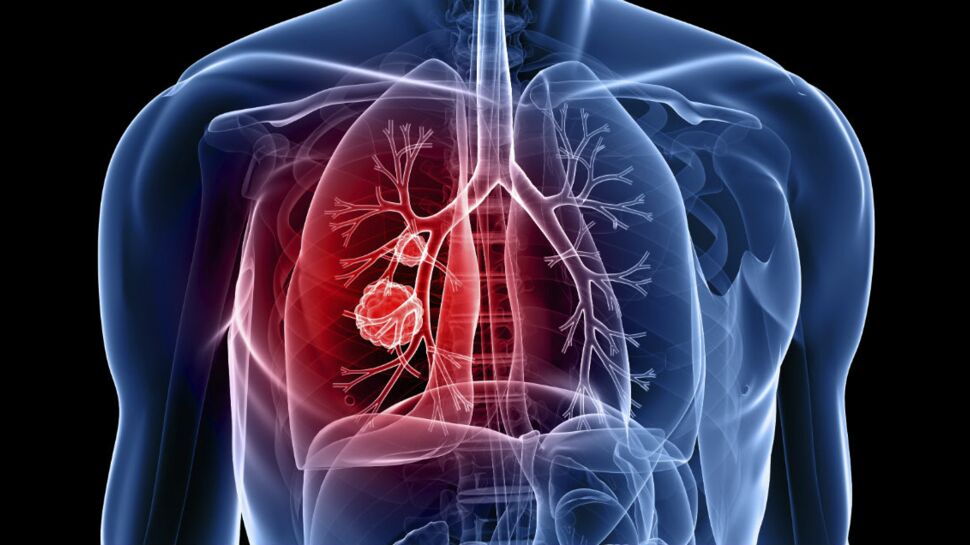 Cancer du poumon : un diagnostic simplifié