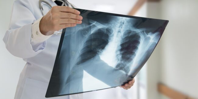 Cancer du poumon : un traitement prometteur bientôt disponible ?