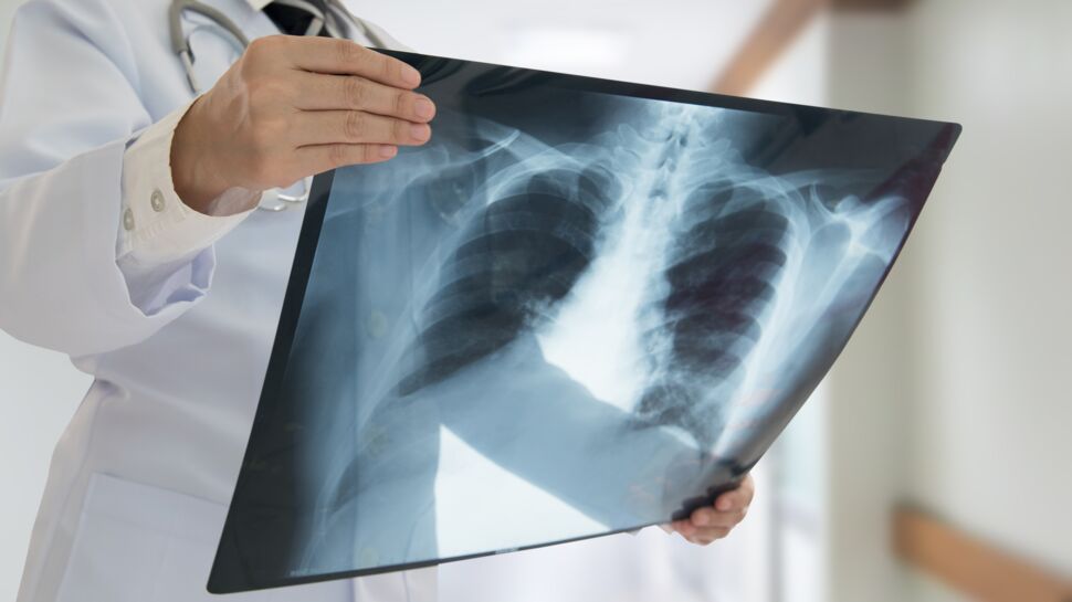Cancer du poumon : un traitement prometteur bientôt disponible ?