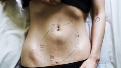 Endometriosis: a photographer displays her belly to raise awareness of the disease