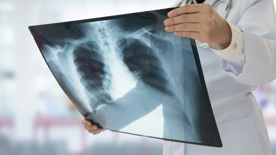 Un étudiant atteint par la tuberculose respiratoire, une maladie très contagieuse
