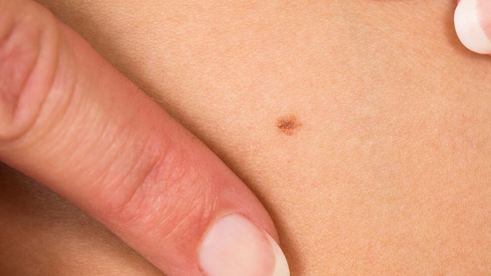 Un implant génère un tatouage en cas de cancer et donne l’alerte
