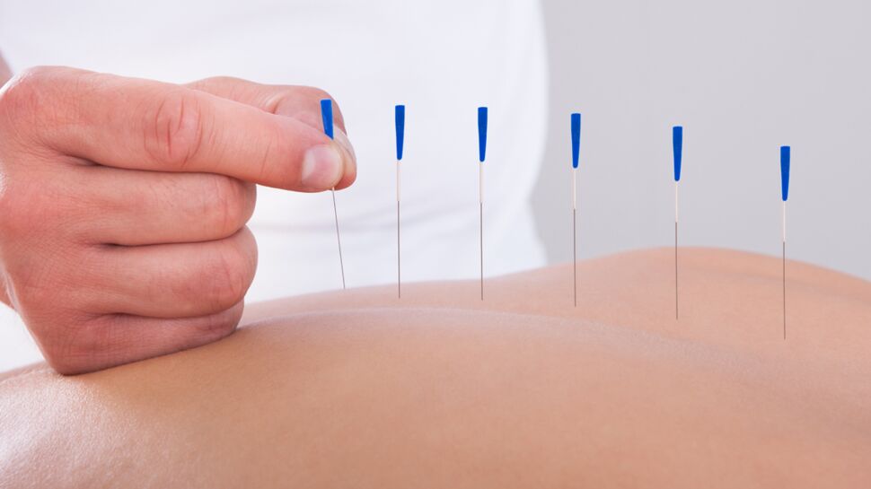 Ménopause : l'acupuncture pour réduire les bouffées de chaleur et les sueurs nocturnes ?