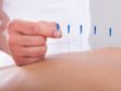 Ménopause : l'acupuncture pour réduire les bouffées de chaleur et les sueurs nocturnes ?
