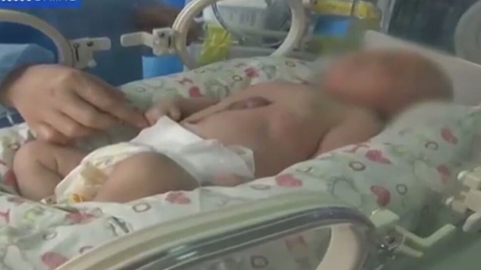 Syndrome de Cantrell : un bébé naît avec le cœur hors de la poitrine