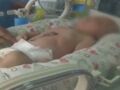 Syndrome de Cantrell : un bébé naît avec le cœur hors de la poitrine