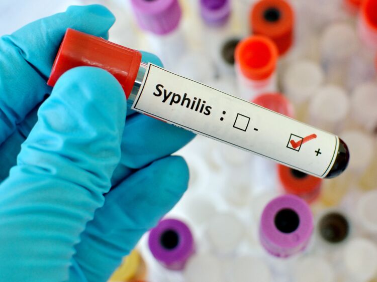 кровь на сифилис: положительно